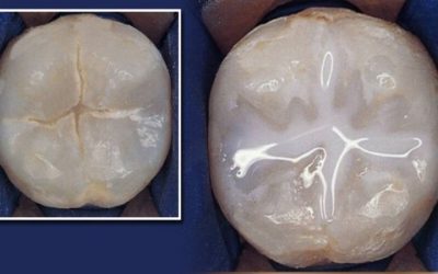 Sigillature dentali: STOP alla carie!